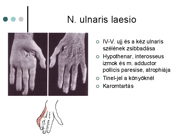 N. ulnaris laesio ¢ ¢ IV-V. ujj és a kéz ulnaris szélének zsibbadása Hypothenar, N. ulnaris laesio ¢ ¢ IV-V. ujj és a kéz ulnaris szélének zsibbadása Hypothenar,