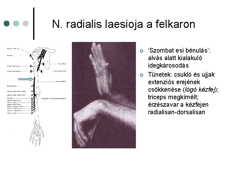 N. radialis laesioja a felkaron ¢ ¢ ‘Szombat esi bénulás’: alvás alatt kialakuló idegkárosodás N. radialis laesioja a felkaron ¢ ¢ ‘Szombat esi bénulás’: alvás alatt kialakuló idegkárosodás