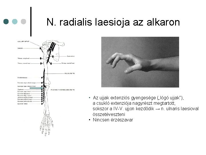 N. radialis laesioja az alkaron • Az ujjak extenziós gyengesége („lógó ujjak”), a csukló N. radialis laesioja az alkaron • Az ujjak extenziós gyengesége („lógó ujjak”), a csukló