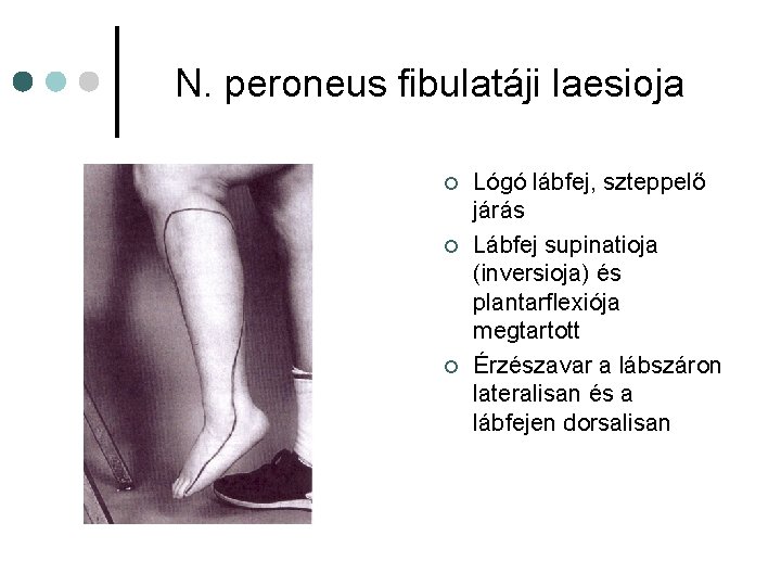 N. peroneus fibulatáji laesioja ¢ ¢ ¢ Lógó lábfej, szteppelő járás Lábfej supinatioja (inversioja) N. peroneus fibulatáji laesioja ¢ ¢ ¢ Lógó lábfej, szteppelő járás Lábfej supinatioja (inversioja)