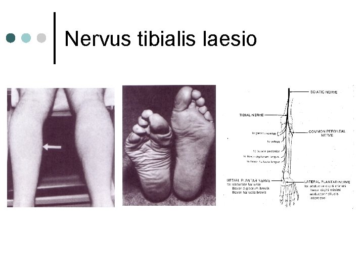 Nervus tibialis laesio Nervus tibialis laesio