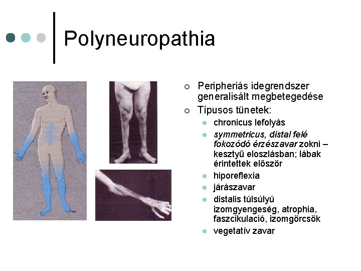 Polyneuropathia ¢ ¢ Peripheriás idegrendszer generalisált megbetegedése Típusos tünetek: l l l chronicus lefolyás Polyneuropathia ¢ ¢ Peripheriás idegrendszer generalisált megbetegedése Típusos tünetek: l l l chronicus lefolyás