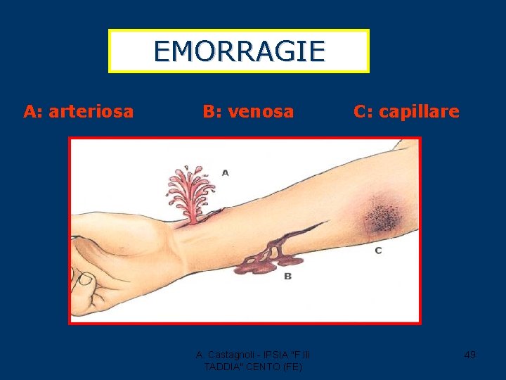 EMORRAGIE A: arteriosa B: venosa A. Castagnoli - IPSIA "F. lli TADDIA" CENTO (FE)