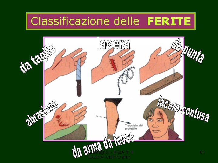 Classificazione delle FERITE A. Castagnoli - IPSIA "F. lli TADDIA" CENTO (FE) 61 