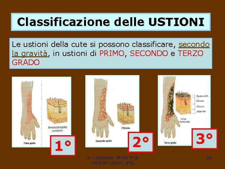 Classificazione delle USTIONI Le ustioni della cute si possono classificare, secondo la gravità, in