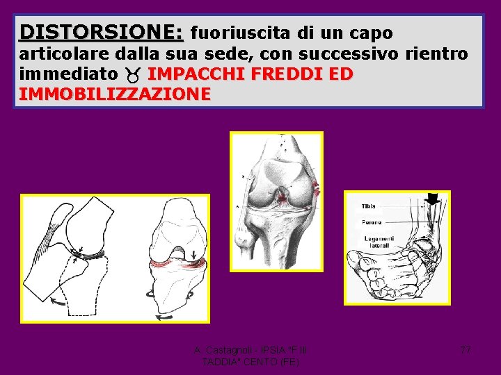 DISTORSIONE: fuoriuscita di un capo articolare dalla sua sede, con successivo rientro immediato IMPACCHI