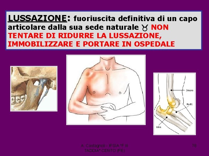 LUSSAZIONE: fuoriuscita definitiva di un capo articolare dalla sua sede naturale NON TENTARE DI