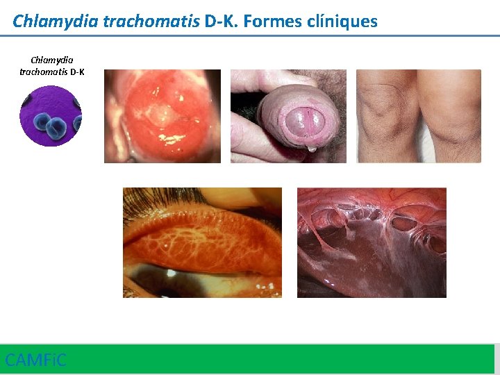 Chlamydia trachomatis D-K. Formes clíniques Chlamydia trachomatis D-K CAMFi. C 16 