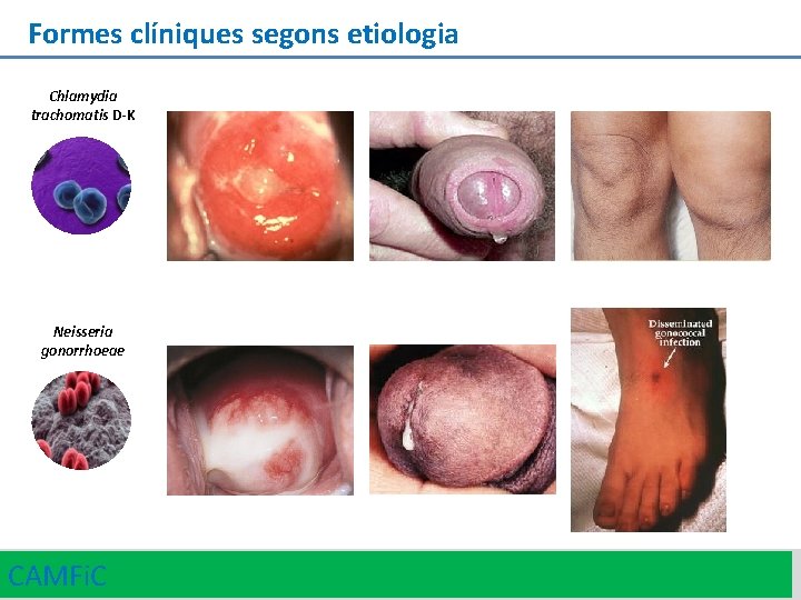 Formes clíniques segons etiologia Chlamydia trachomatis D-K Neisseria gonorrhoeae CAMFi. C 20 