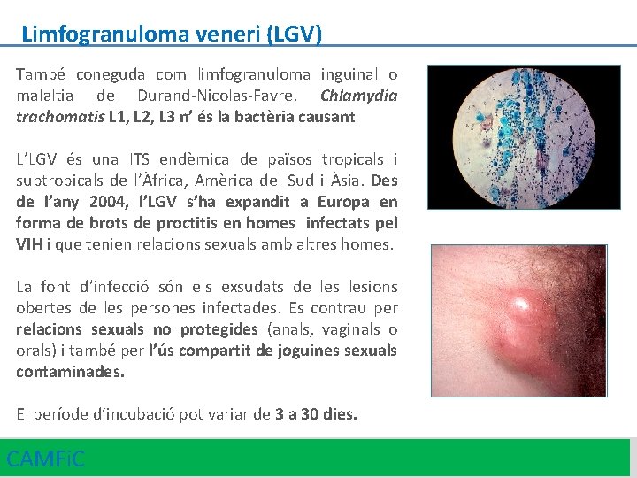 Limfogranuloma veneri (LGV) També coneguda com limfogranuloma inguinal o malaltia de Durand-Nicolas-Favre. Chlamydia trachomatis
