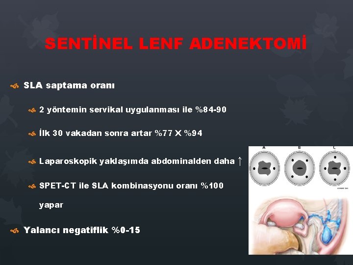 SENTİNEL LENF ADENEKTOMİ SLA saptama oranı 2 yöntemin servikal uygulanması ile %84 -90 İlk SENTİNEL LENF ADENEKTOMİ SLA saptama oranı 2 yöntemin servikal uygulanması ile %84 -90 İlk