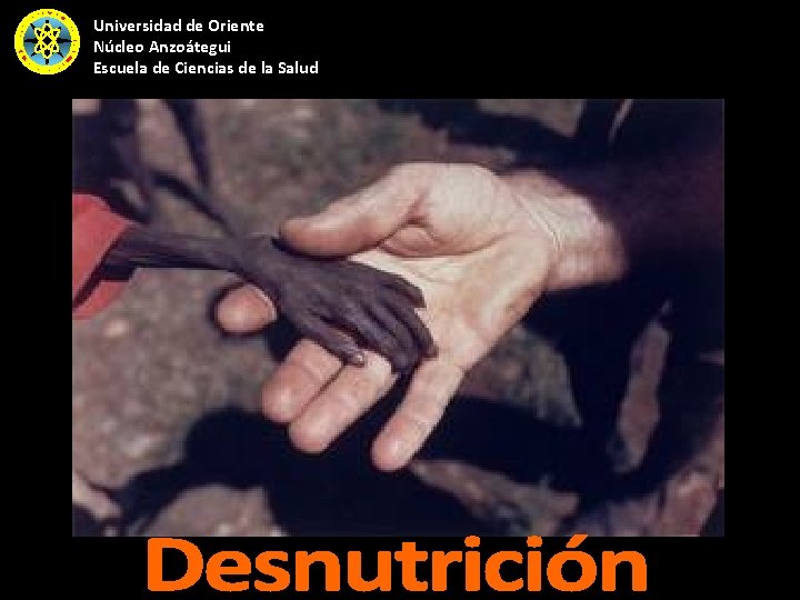 Universidad de Oriente Núcleo Anzoátegui Escuela de Ciencias de la Salud 