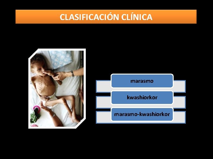 CLASIFICACIÓN CLÍNICA marasmo kwashiorkor marasmo-kwashiorkor 