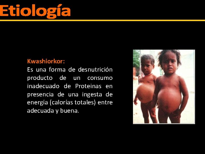 Kwashiorkor: Es una forma de desnutrición producto de un consumo inadecuado de Proteinas en