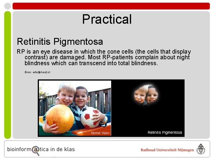 Practical Retinitis Pigmentosa RP is an eye disease in which the cone cells (the