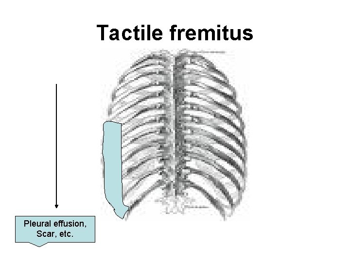 Tactile fremitus Pleural effusion, Scar, etc. 