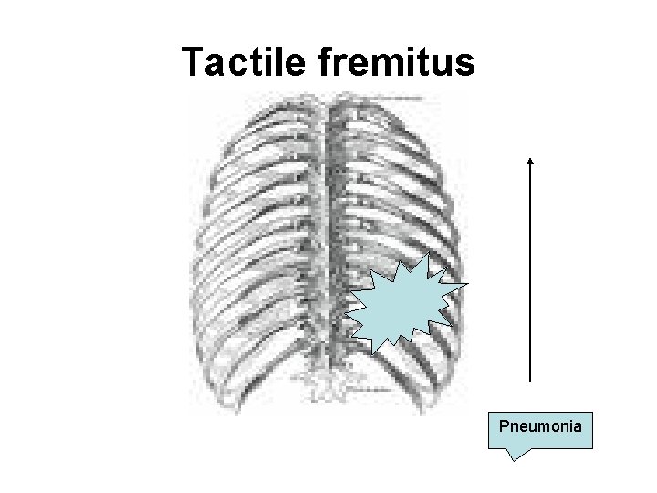 Tactile fremitus Pneumonia 