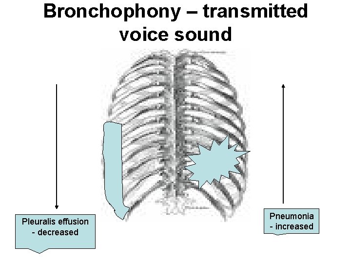 Bronchophony – transmitted voice sound Pleuralis effusion - decreased Pneumonia - increased 