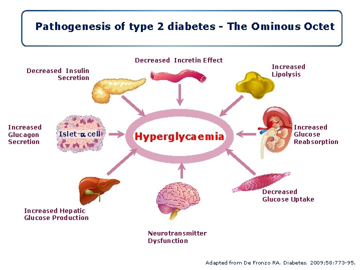 Pathogenesis of type 2 diabetes - The Ominous Octet Decreased Incretin Effect Decreased Insulin