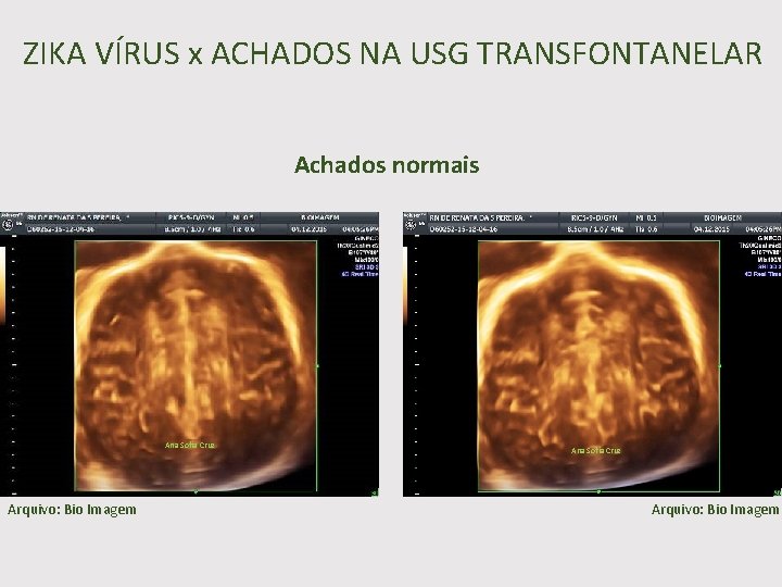 ZIKA VÍRUS x ACHADOS NA USG TRANSFONTANELAR Achados normais Ana Sofia Cruz Arquivo: Bio