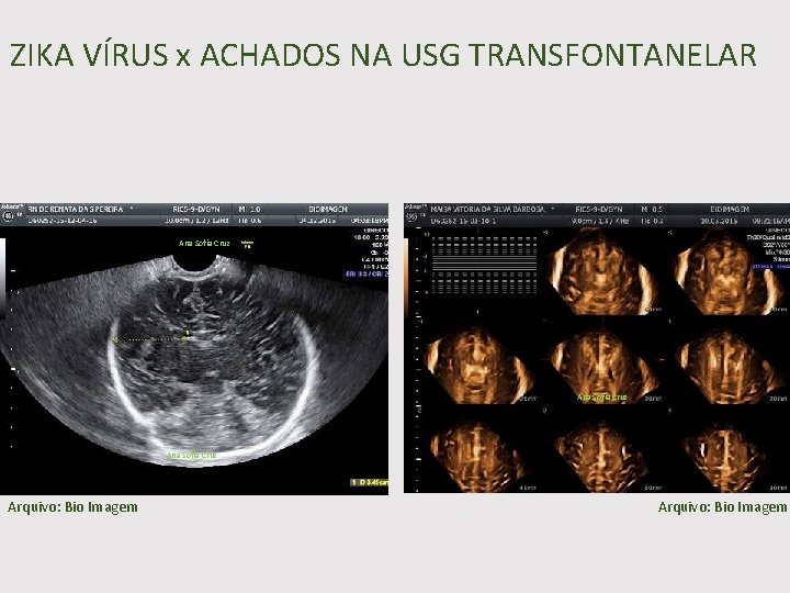 ZIKA VÍRUS x ACHADOS NA USG TRANSFONTANELAR Ana Sofia Cruz Arquivo: Bio Imagem 