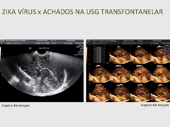 ZIKA VÍRUS x ACHADOS NA USG TRANSFONTANELAR Ana Sofia Cruz Arquivo: Bio Imagem 