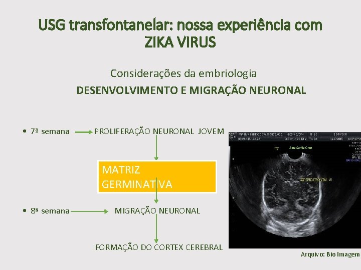 USG transfontanelar: nossa experiência com ZIKA VIRUS Considerações da embriologia DESENVOLVIMENTO E MIGRAÇÃO NEURONAL