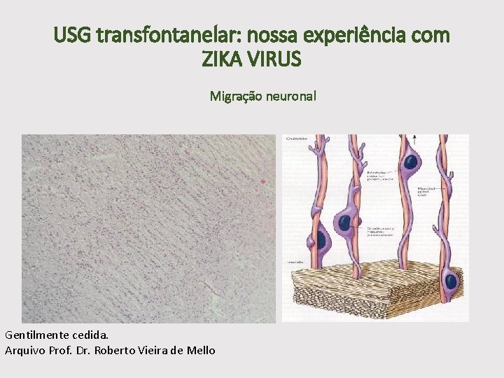 USG transfontanelar: nossa experiência com ZIKA VIRUS Migração neuronal Gentilmente cedida. Arquivo Prof. Dr.
