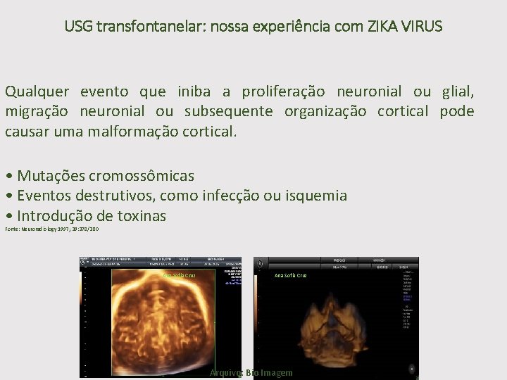 USG transfontanelar: nossa experiência com ZIKA VIRUS Qualquer evento que iniba a proliferação neuronial