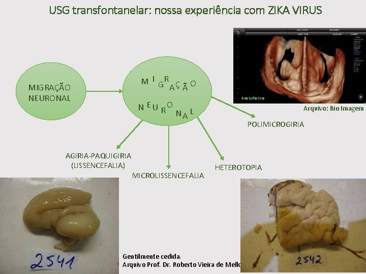 USG transfontanelar: nossa experiência com ZIKA VIRUS M I GR Ç O A Ã