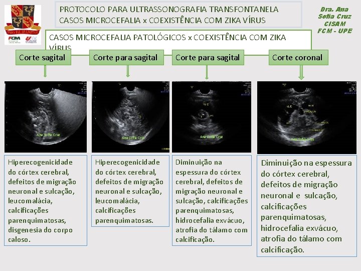 PROTOCOLO PARA ULTRASSONOGRAFIA TRANSFONTANELA CASOS MICROCEFALIA x COEXISTÊNCIA COM ZIKA VÍRUS Dra. Ana Sofia