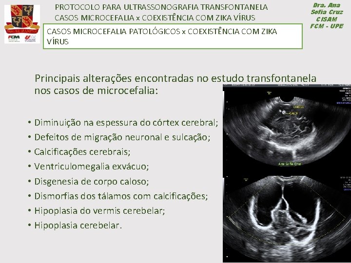 PROTOCOLO PARA ULTRASSONOGRAFIA TRANSFONTANELA CASOS MICROCEFALIA x COEXISTÊNCIA COM ZIKA VÍRUS CASOSMICROCEFALIAPATOLÓGICOSxx. COEXISTÊNCIACOM COMZIKAVÍRUS