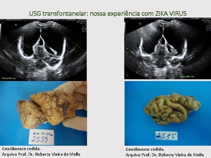 USG transfontanelar: nossa experiência com ZIKA VIRUS Ana Sofia Cruz Gentilmente cedida. Arquivo Prof.