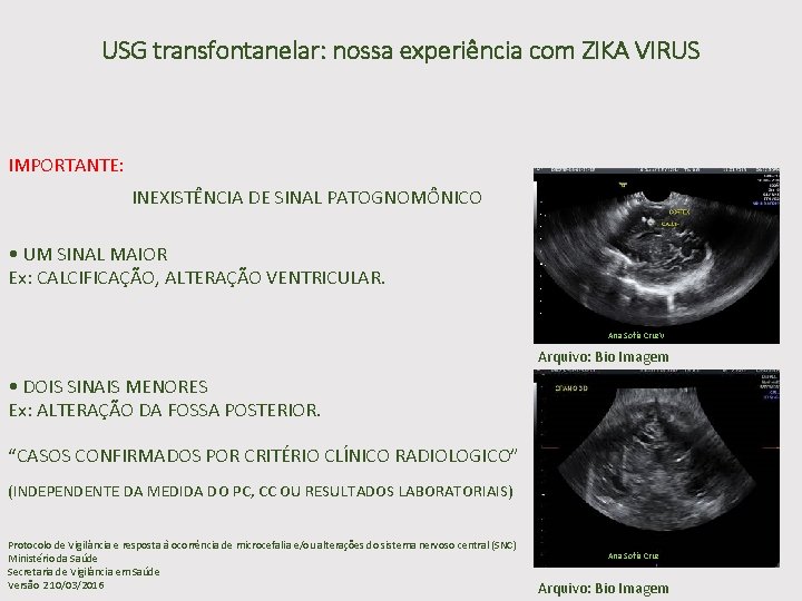 USG transfontanelar: nossa experiência com ZIKA VIRUS IMPORTANTE: INEXISTÊNCIA DE SINAL PATOGNOMÔNICO • UM
