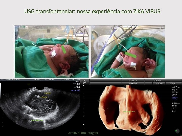 USG transfontanelar: nossa experiência com ZIKA VIRUS Ana Sofia Cruz Arquivo: Bio Imagem 