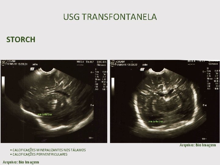 USG TRANSFONTANELA STORCH Ana Sofia Cruz • CALCIFICAÇÕES MINERALIZANTES NOS TÁLAMOS • CALCIFICAÇÕES PERIVENTRICULARES