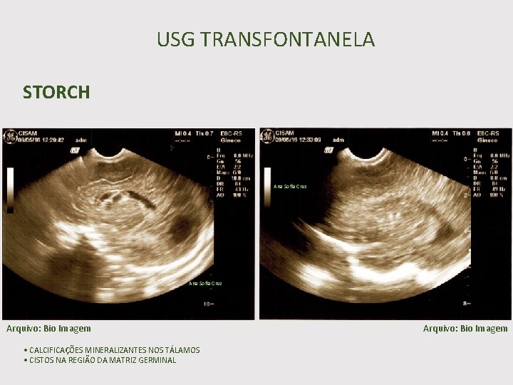 USG TRANSFONTANELA STORCH Ana Sofia Cruz Arquivo: Bio Imagem • CALCIFICAÇÕES MINERALIZANTES NOS TÁLAMOS