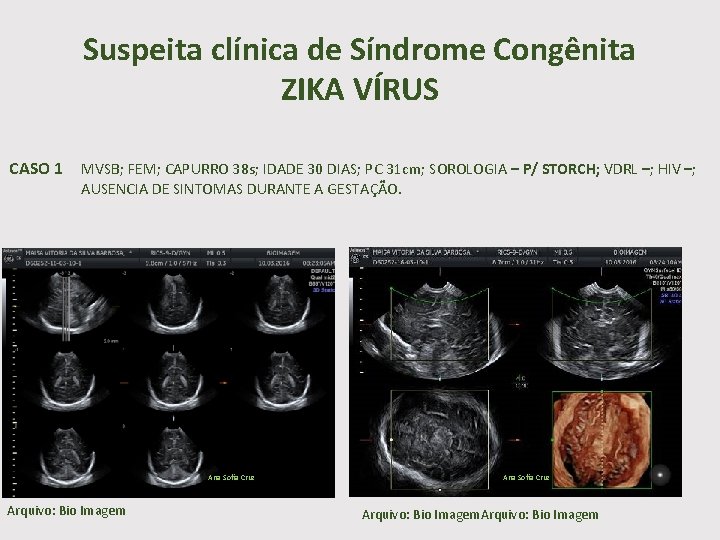 Suspeita clínica de Síndrome Congênita ZIKA VÍRUS CASO 1 MVSB; FEM; CAPURRO 38 s;