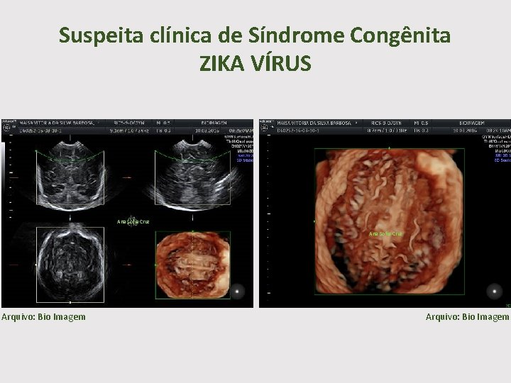 Suspeita clínica de Síndrome Congênita ZIKA VÍRUS Ana Sofia Cruz Arquivo: Bio Imagem 
