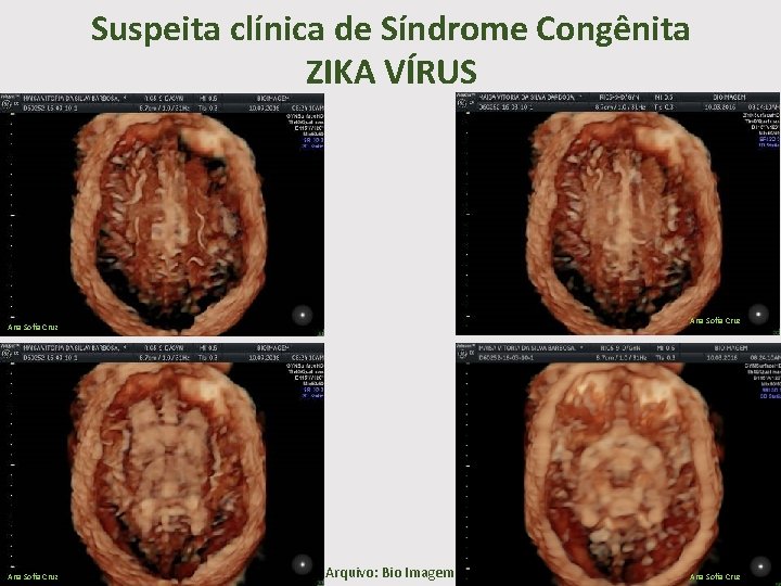 Suspeita clínica de Síndrome Congênita ZIKA VÍRUS Ana Sofia Cruz Arquivo: Bio Imagem Ana