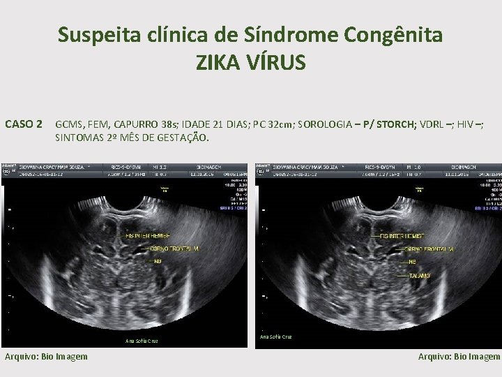 Suspeita clínica de Síndrome Congênita ZIKA VÍRUS CASO 2 GCMS, FEM, CAPURRO 38 s;