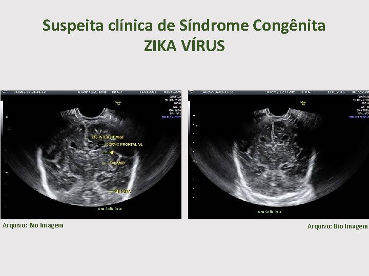 Suspeita clínica de Síndrome Congênita ZIKA VÍRUS Ana Sofia Cruz Arquivo: Bio Imagem 