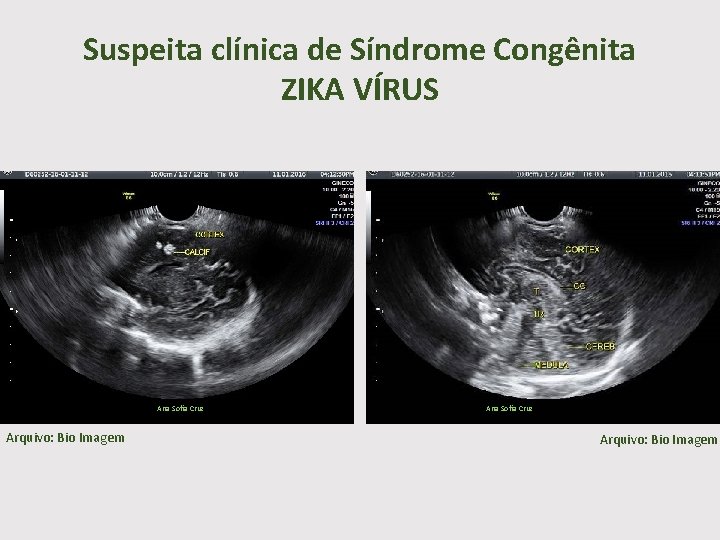 Suspeita clínica de Síndrome Congênita ZIKA VÍRUS Ana Sofia Cruz Arquivo: Bio Imagem 