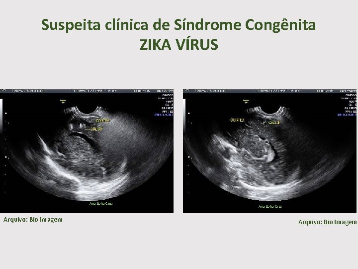 Suspeita clínica de Síndrome Congênita ZIKA VÍRUS Ana Sofia Cruz Arquivo: Bio Imagem 