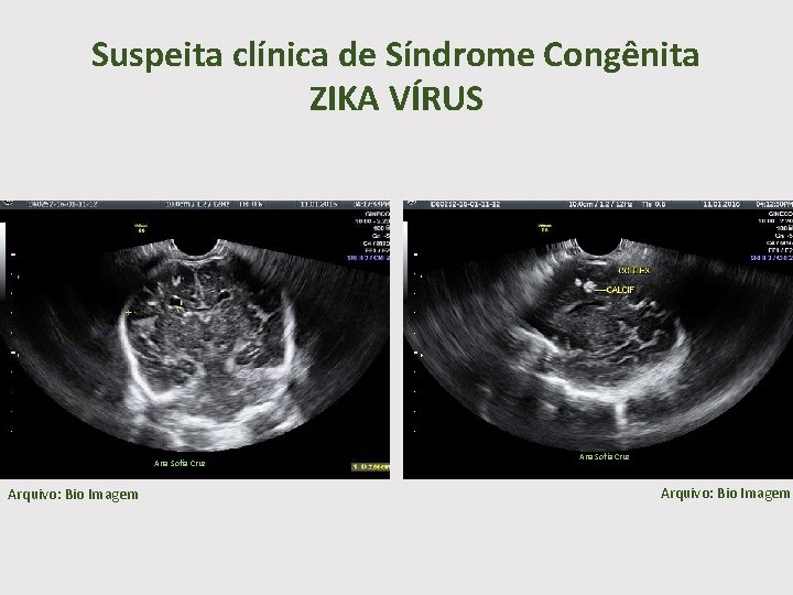 Suspeita clínica de Síndrome Congênita ZIKA VÍRUS Ana Sofia Cruz Arquivo: Bio Imagem 