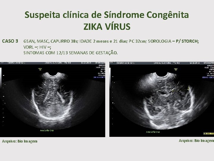 Suspeita clínica de Síndrome Congênita ZIKA VÍRUS CASO 3 GSAN, MASC, CAPURRO 38 s;