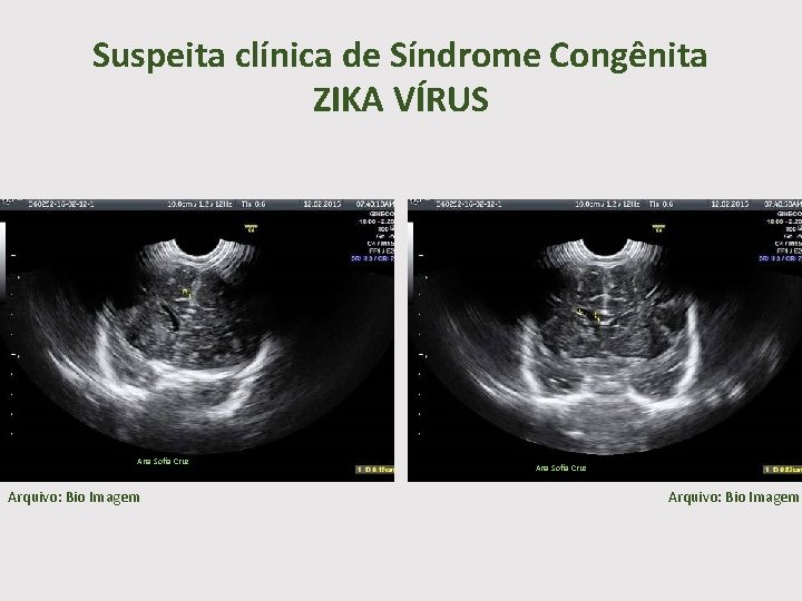 Suspeita clínica de Síndrome Congênita ZIKA VÍRUS Ana Sofia Cruz Arquivo: Bio Imagem 