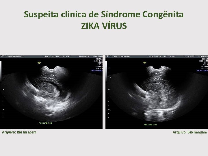 Suspeita clínica de Síndrome Congênita ZIKA VÍRUS Ana Sofia Cruz Arquivo: Bio Imagem 
