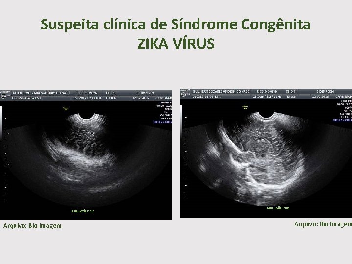 Suspeita clínica de Síndrome Congênita ZIKA VÍRUS Ana Sofia Cruz Arquivo: Bio Imagem 