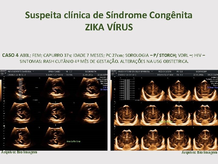 Suspeita clínica de Síndrome Congênita ZIKA VÍRUS CASO 4 ABBL; FEM; CAPURRO 37 s;